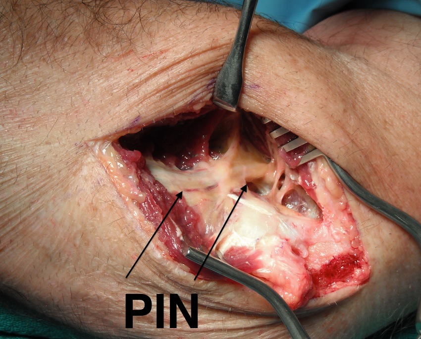 PIN in radial tunnel release